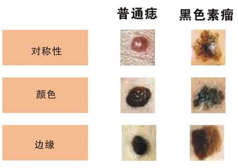 臉上多了痣|是痣還是瘤？黑色素瘤的類型、症狀與治療